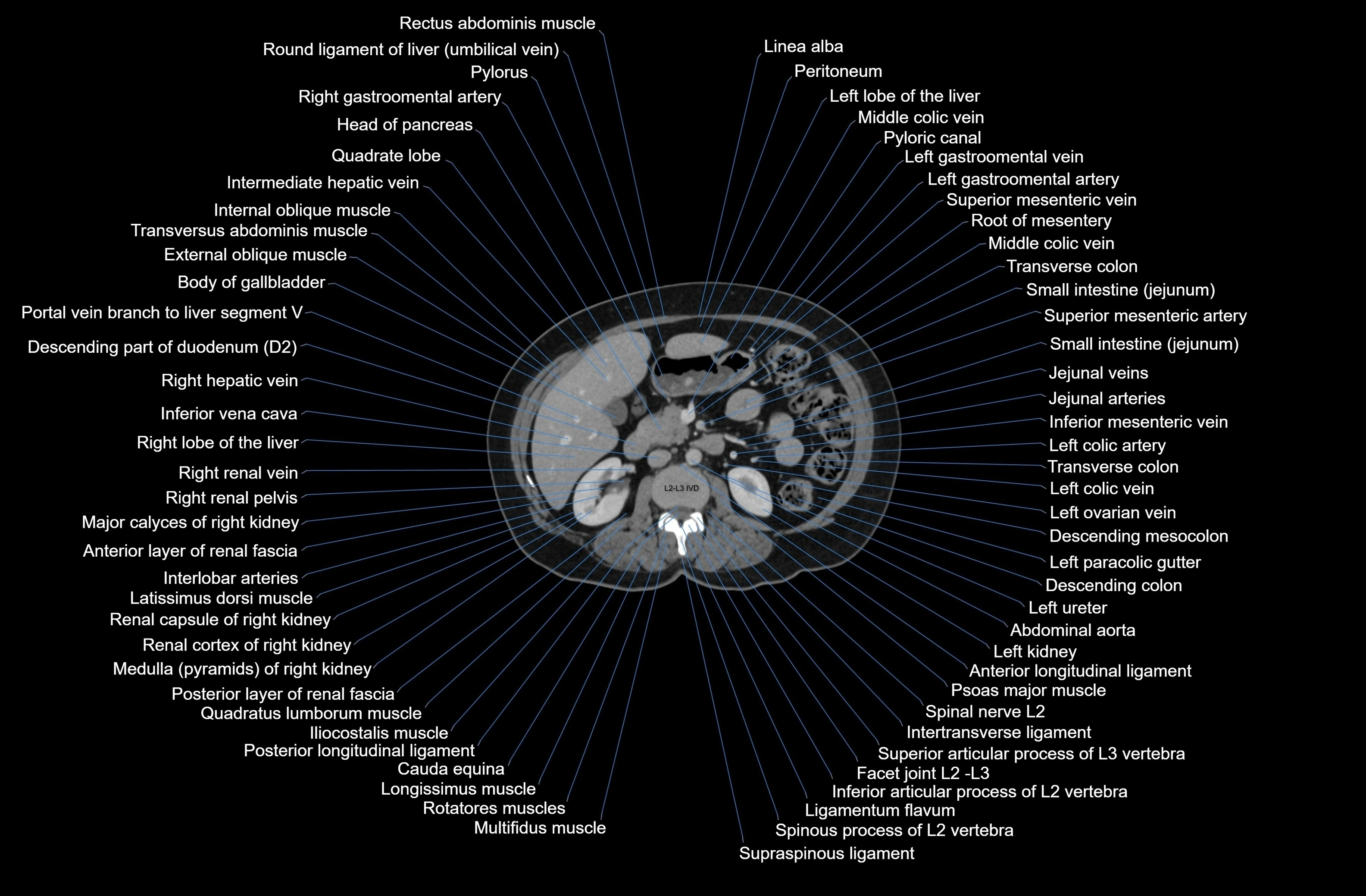 CT Abdomen axial cross sectional anatomy labelled radiology image-00038.webp